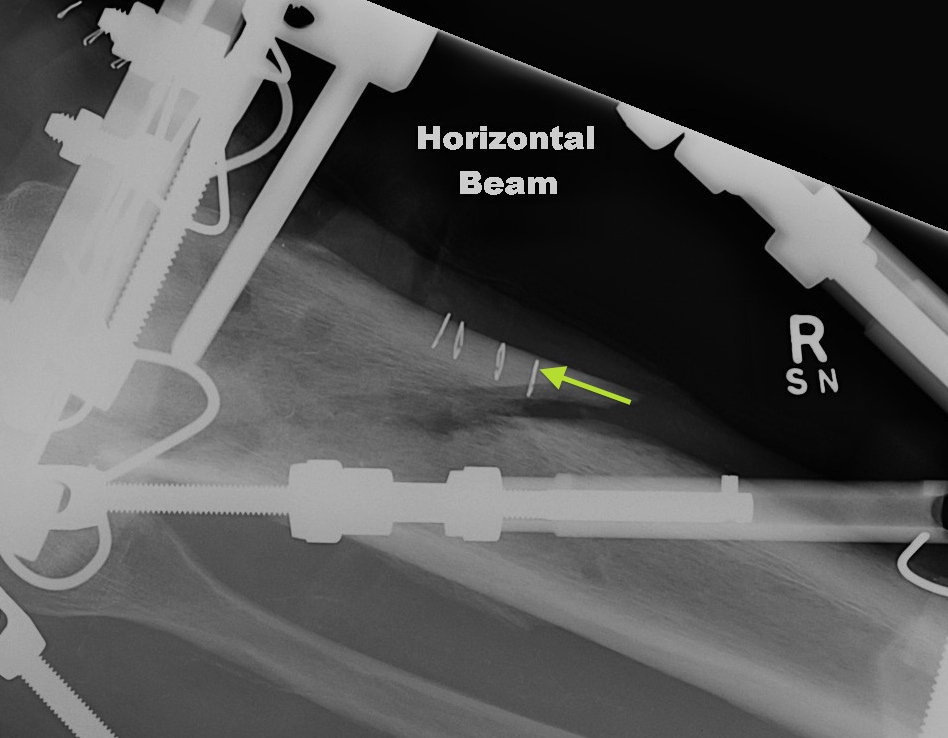 TSF Axial Translation